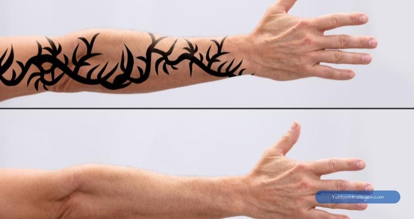 laser tattoo removal before after - Tattoo Strategies