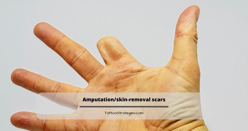 Amputation skin-removal scars
