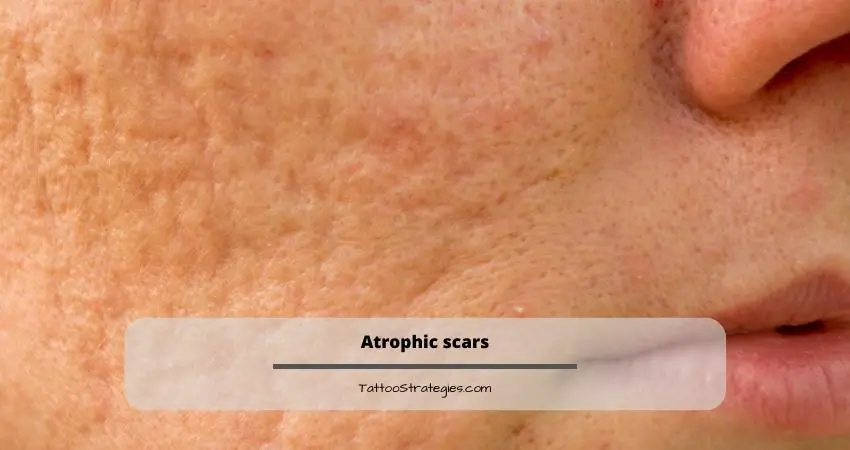 Atrophic scars