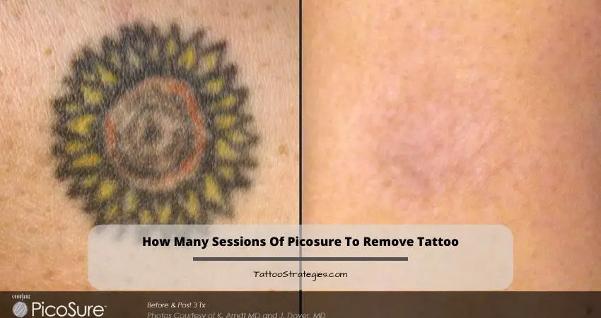 How Many Sessions Of Picosure To Remove Tattoo
