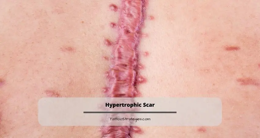 Hypertrophic Scar