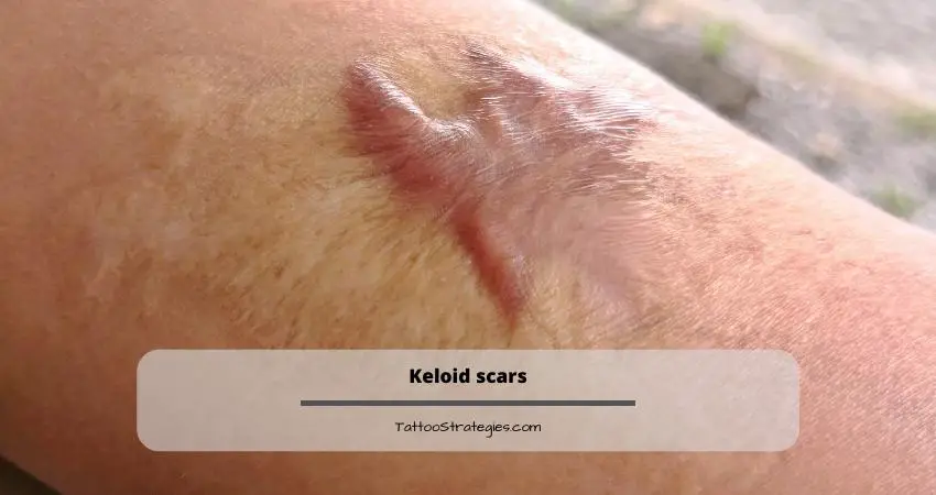 Keloid scars