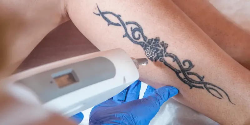 PicoSure Laser Tattoo Removal